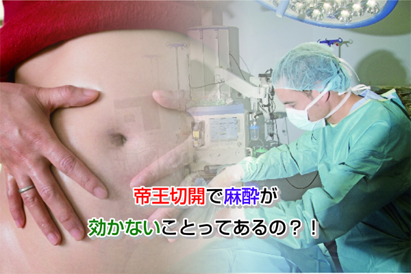 Anesthesia in cesarean section Eye-catching image
